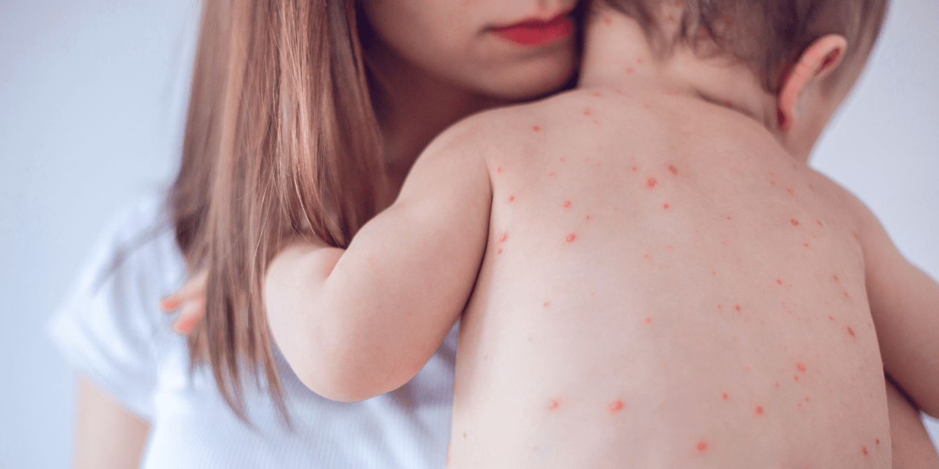 Measles in Arizona 2026:  Who’s Vulnerable? East Valley Measles Risks Explained