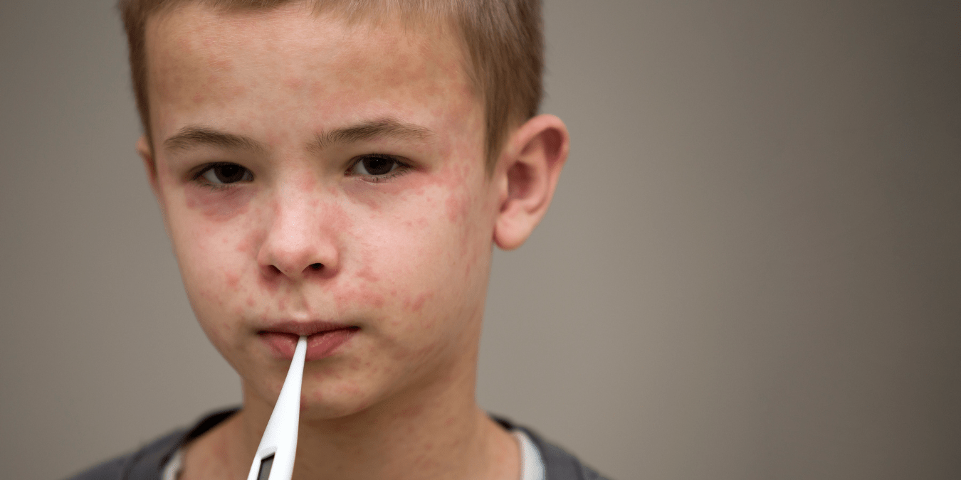 Mpox Is Back — But This Strain Is Deadlier. What the First Mpox Clade I Case in New York City Actually Means for the Rest of America 1 Mpox Is Back — But This Strain Is Deadlier. What the First Mpox Clade I Case in New York City Actually Means for the Rest of America